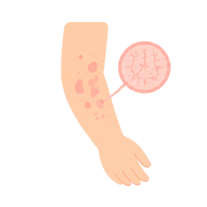 síntomas del linfedema: Cambios en la piel.